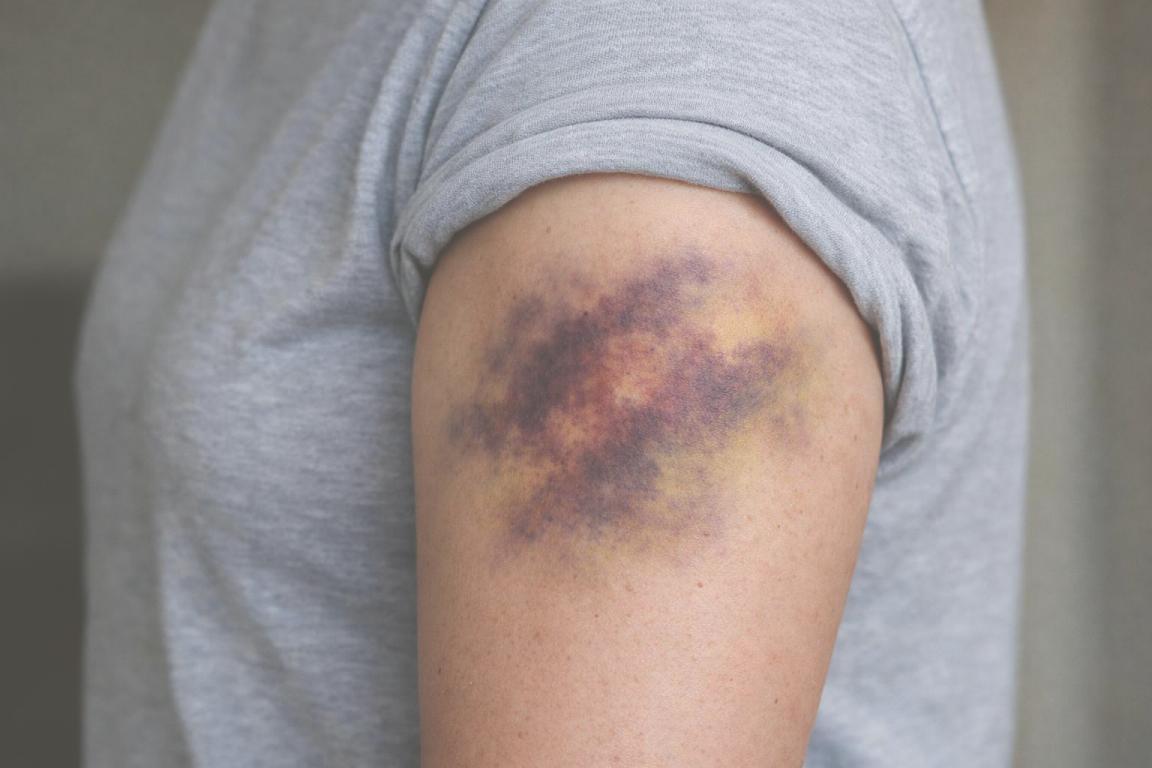 KI-generiertes Foto eines Oberkörpers. Die Person trägt ein graues T-Shirt, der Ärmel ist hochgekrempelt und am Oberarm gibt es einen grossen blauen Fleck.