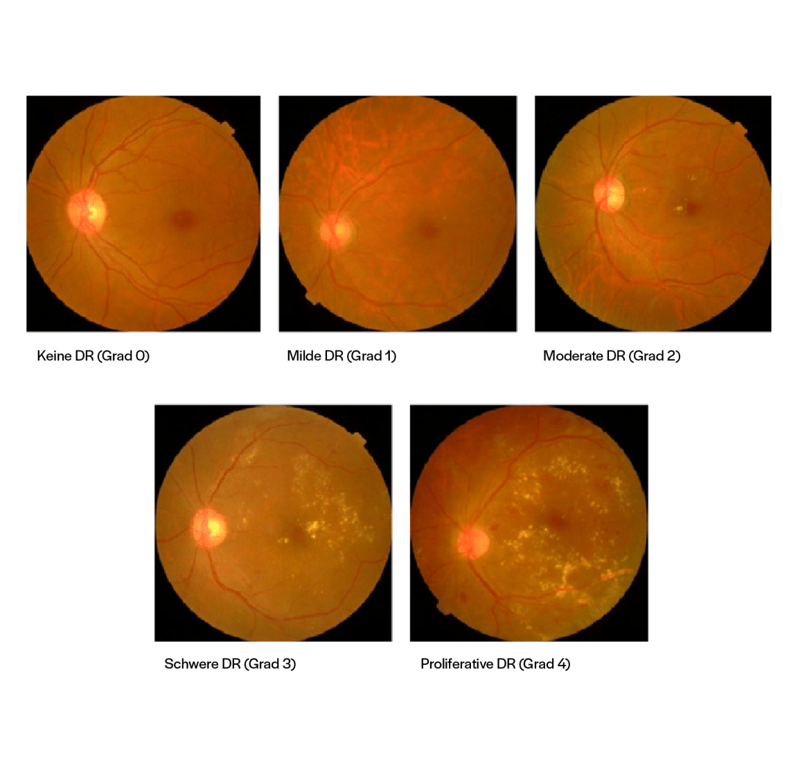 Aufnahmen von Augenwänden mit Graden der diabetischen Retinopathie